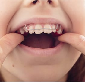 こどもが矯正器具を装着