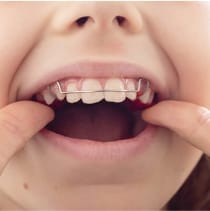 こどもが矯正器具を装着