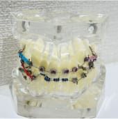 ブラケット(ワイヤー)装置