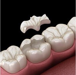 インレー・クラウン