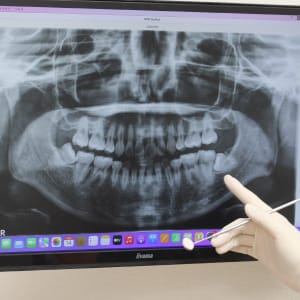 患者のレントゲンより根尖病巣を確認