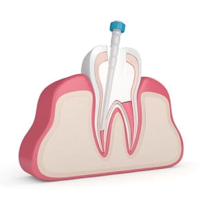 歯の根管を治療