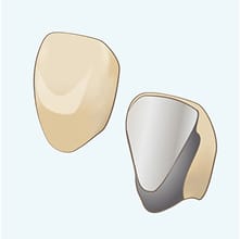 プラスチック前装冠