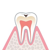 エナメル質う蝕