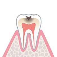 象牙質う蝕