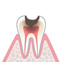 歯髄まで侵されたむし歯