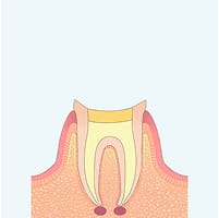 根管内の洗浄・消毒