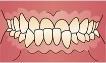 下顎前突(受け口)