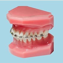 金属ブラケットとワイヤーを使用した矯正装置