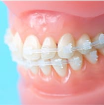 透明なブラケットを使用した矯正装置