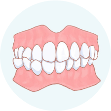 噛み合わせが悪い