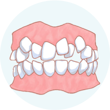 歯並びがガタガタ