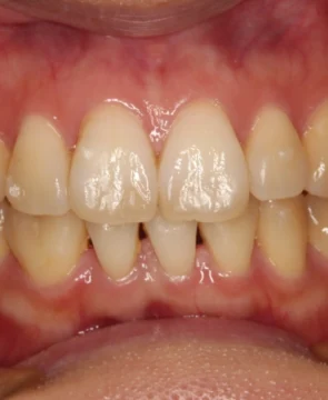 前歯のがたつきが気になる