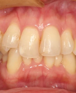 全体的な歯のがたつきが気になる