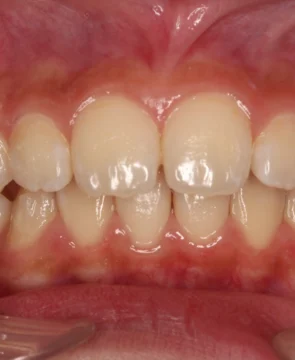 前歯が出ているのが気になる