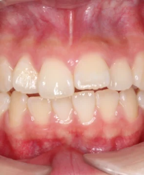 前歯の突出、捻じれが気になる