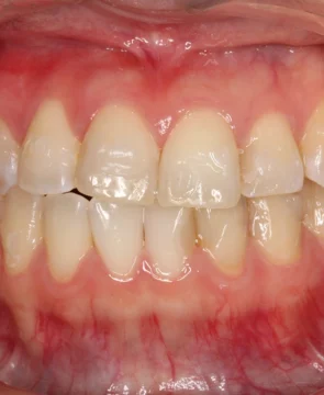 前歯のがたつき・捩れが気になる