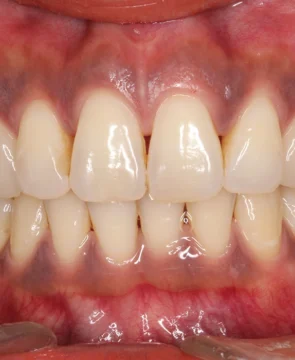 下の歯のがたつきが気になる