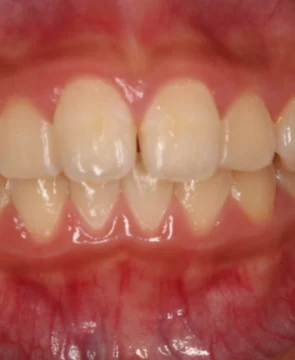 出っ歯とガタツキが気になる