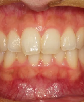 全体的な歯列のがたつきが気になる