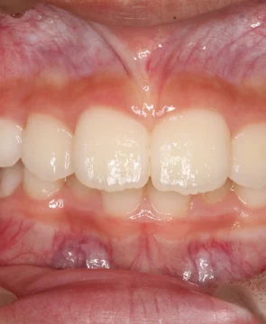 歯並びのデコボコが気になる