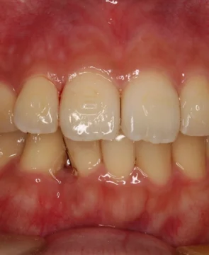 下顎の前歯のがたつきが気になる