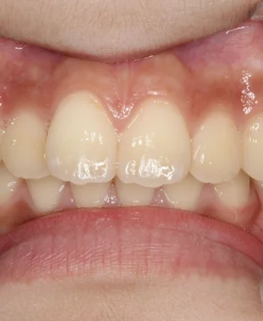 前歯が出ているのが気になる