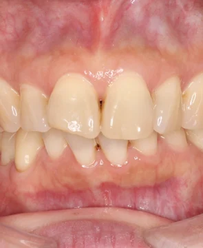 上下の歯並びのがたつきが気になる