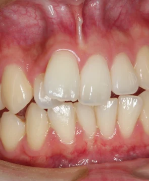 全体的な歯のガタツキが気になる