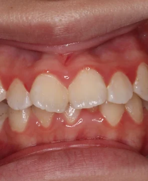 歯並びのがたつきが気になる