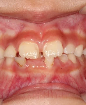 下の歯並びのがたつきが気になる