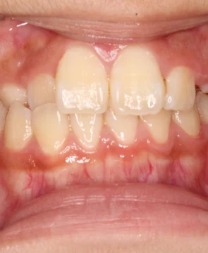 全体的な歯並びのガタツキが気になる