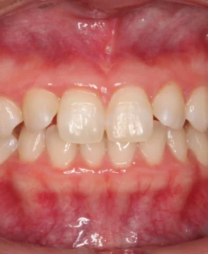 上下前歯の捻じれが気になる