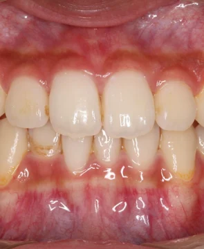 左上の歯並びが気になる