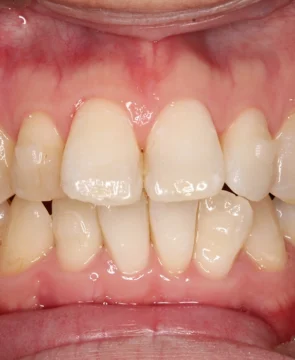 前歯の突出が気になる