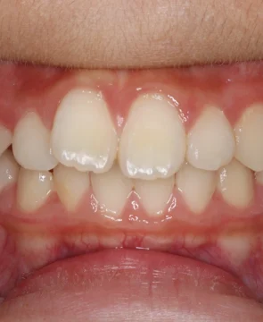 口元が前に出ていることが気になる