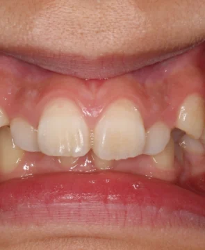 前歯が出ているのが気になる