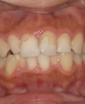 上下の歯並びのガタツキが気になる