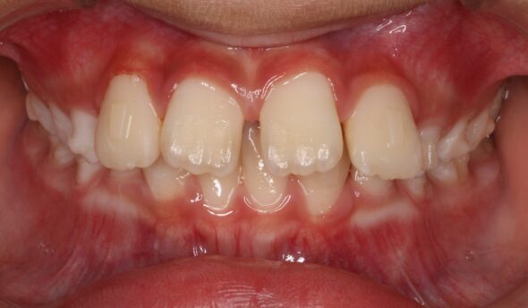 上顎前歯部が出ていることが気になる