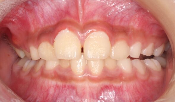 全体的な歯並びのがたつきが気になる