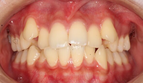 上顎前歯部の重なりが気になる