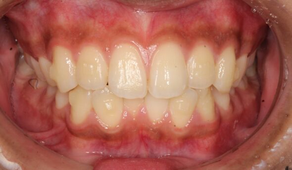 下顎の前歯のガタツキが気になる