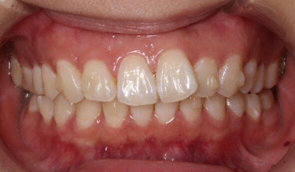 全体的な歯並びのがたつきが気になる