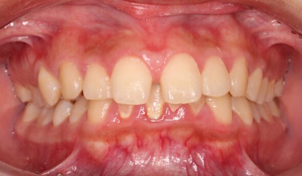 上顎前歯の離開、左下に残っている乳歯が気になる