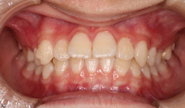 噛み合わせのズレ、上顎前歯の突出が気になる