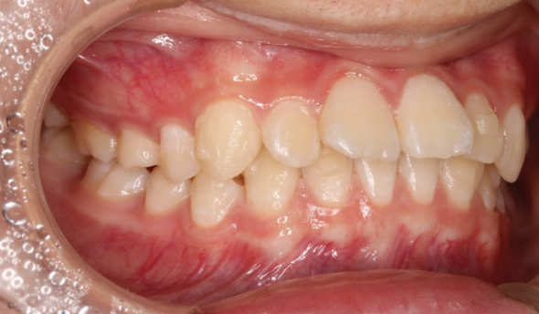 インビザラインで上だけ矯正はできる？できる歯並び・できない歯並びを紹介