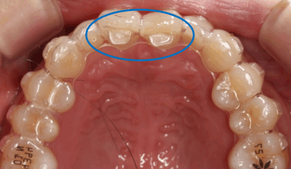 インビザラインのバイトランプとは？役割と併せて痛みや見た目への影響なども解説