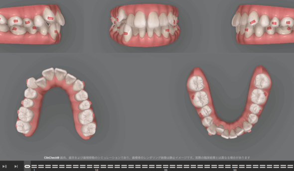 インビザラインのクリンチェックとは？役割やメリットを歯科医師が解説