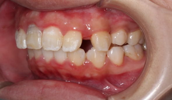 インビザラインの平均枚数は何枚？枚数が増えるケースや変化を感じられる枚数なども紹介