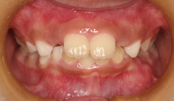 全体的ながたつきと上の歯が出ていることが気になる